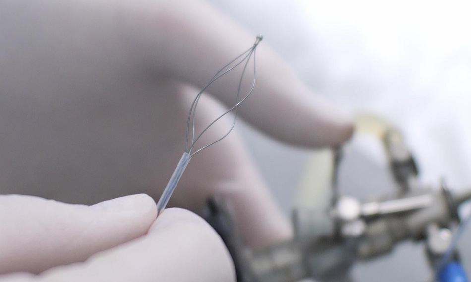 Bone fragments after TFL surgery